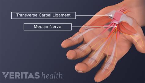 Is My Hand Pain from Carpal Tunnel Syndrome or Something Else? | Spine-health