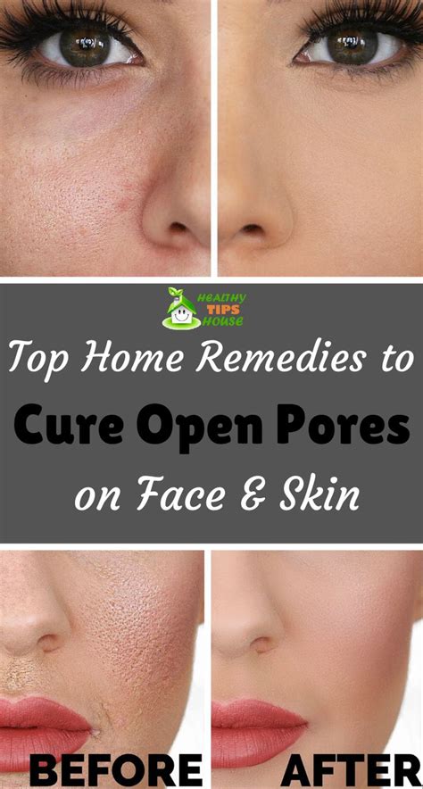 Use these natural remedies to put an end to Open Pores! | Open pores on face, Pore treatment ...