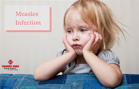 Measles Infection: Symptoms, Causes, Treatment, & Prevention