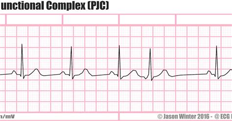 ECG Educator Blog : Premature Junctional Complex (PJC)