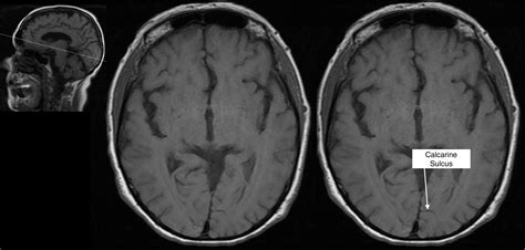 Radiological Anatomy: Calcarine Sulcus - Stepwards