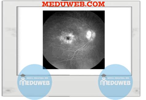 Cystoid macular oedema - Meduweb