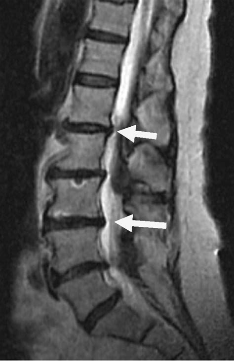 Thoracic Spine Mri Herniated Disc