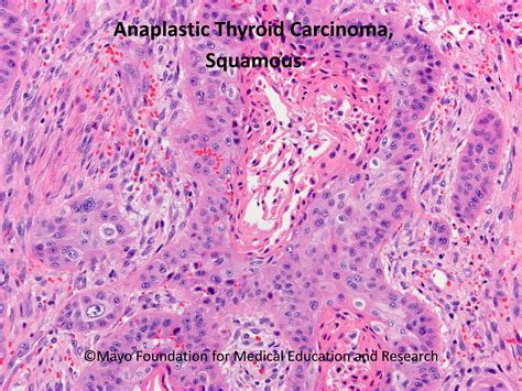 Anaplastic Thyroid Carcinoma - Mayo Clinic Proceedings