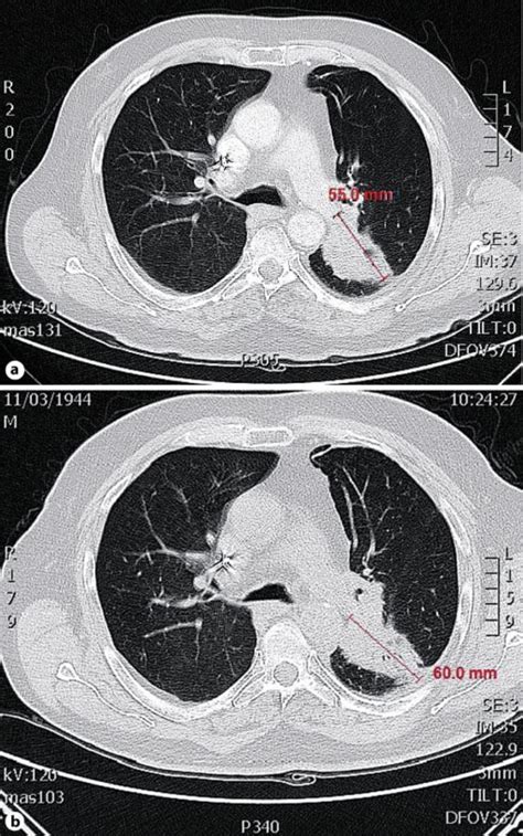 Octreotide scan imaging at recurrence (a) and at the time of the ...