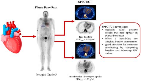 JCDD | Free Full-Text | Quantitative SPECT/CT Parameters in the ...