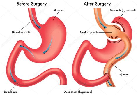 Gastric bypass — Stock Vector © rob3000 #65090903