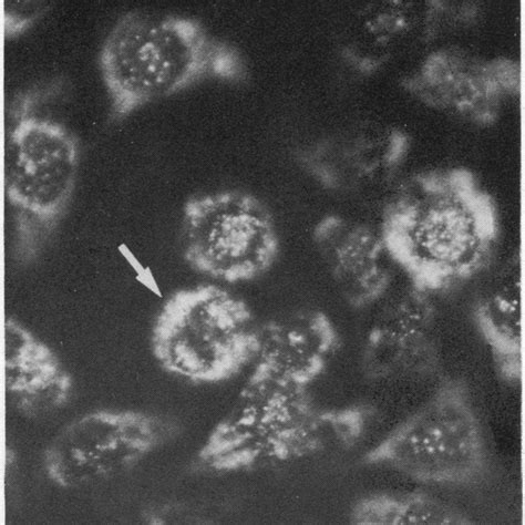 (PDF) Anticentromere antibody in primary biliary cirrhosis