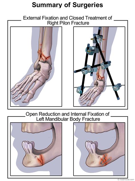 Medmovie.com | Summary of Injuries and Surgical Repair