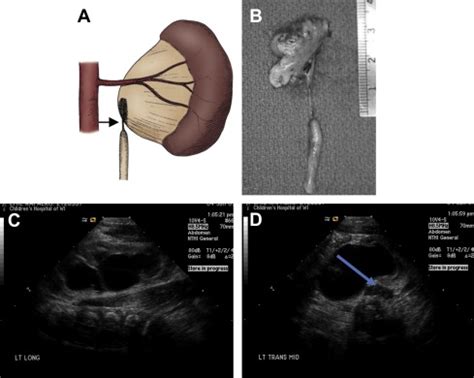 Hydronephrosis | Obgyn Key