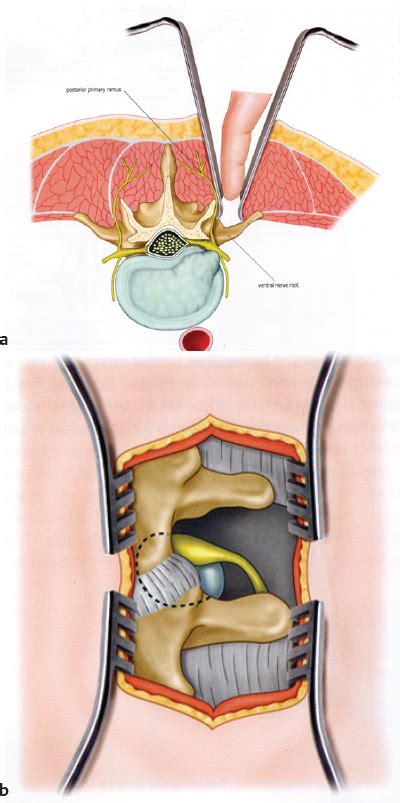 Minimally Invasive Tubular Decompression for Foraminal Stenosis ...