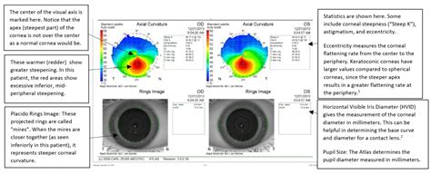 Moran CORE | A Brief Overview of Keratoconus and its Topographical Findings