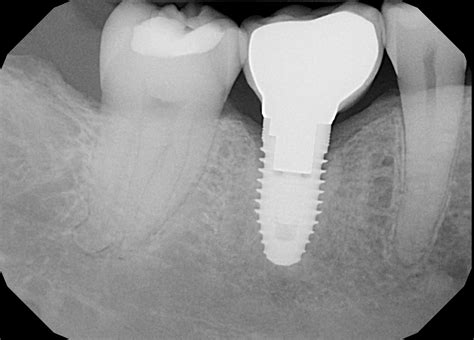 Dental X-ray Safety Facts | Penn Dental Medicine