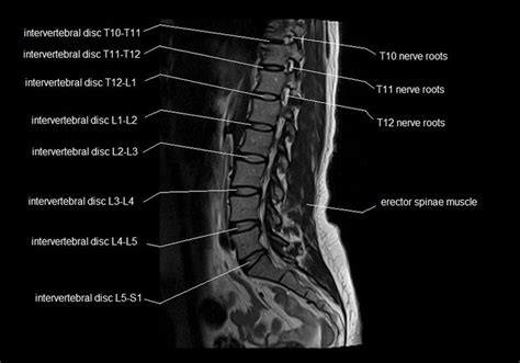 MRI spine anatomy | free MRI lumbar spine sagittal cross sectional ...