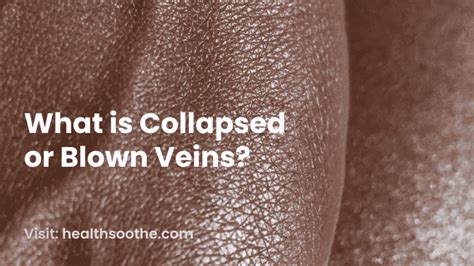 Collapsed Vein | Symptoms, Causes, Treatments, And Prevention