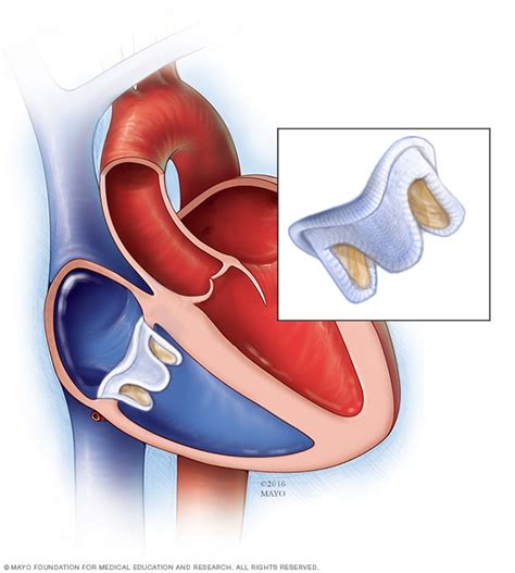 life expectancy after aortic valve replacement - Juan Marks