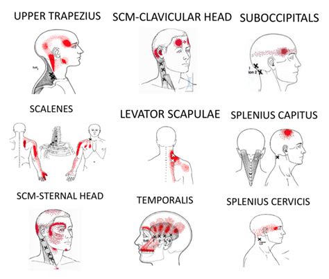 Get Relief From Tension Headaches - The Armoury