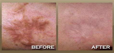 Skinpeccable | Scar Removal | Los Angeles