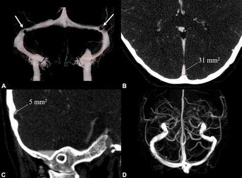 Transverse Sinus Mri