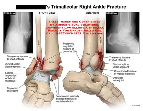 Trimalleolar Right Ankle Fracture