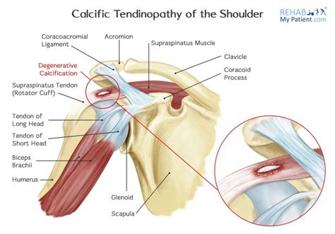 Calcification in your shoulder – shockwave can help | The Body Refinery