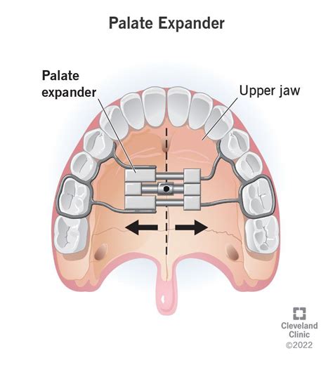 Palate Expander: Uses, Types & Adjusting | Palate expander, Teeth ...