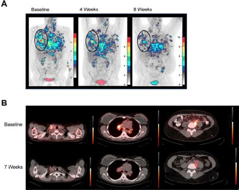 18 FDG-PET responses. (A) 18 FDG-PET before and at 4 and 8 weeks after ...