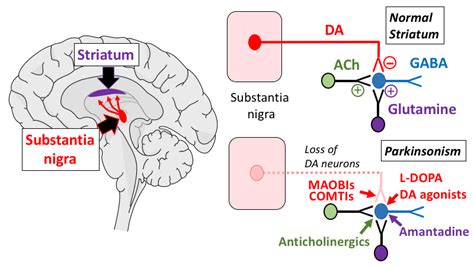 Role of Anticholinergics in Parkinson’s Disease Treatment – Deep Brain ...