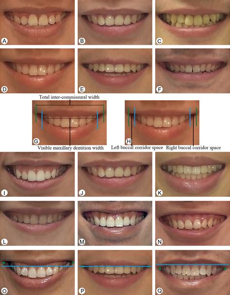 -Examples of smile variables collected from left to right. A, B, C ...