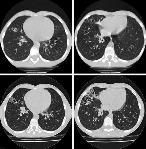 -Patient with cystic fibrosis with improvement of lung function but... | Download Scientific Diagram