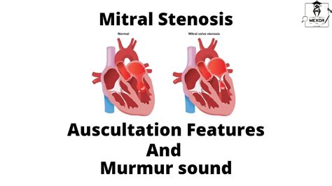 Mitral Stenosis Auscultation features & Murmur sound description - YouTube