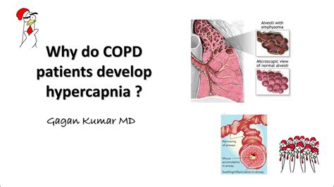 Why does COPD cause hypercapnia ? - YouTube