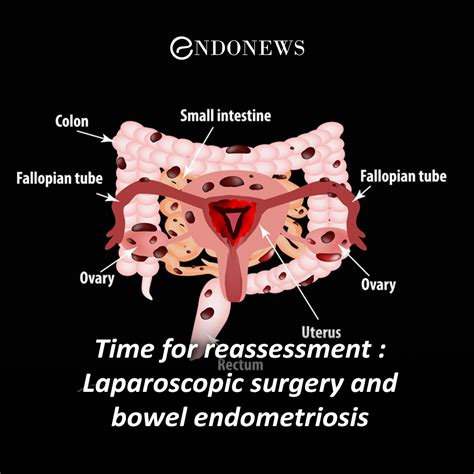 Endometriosis