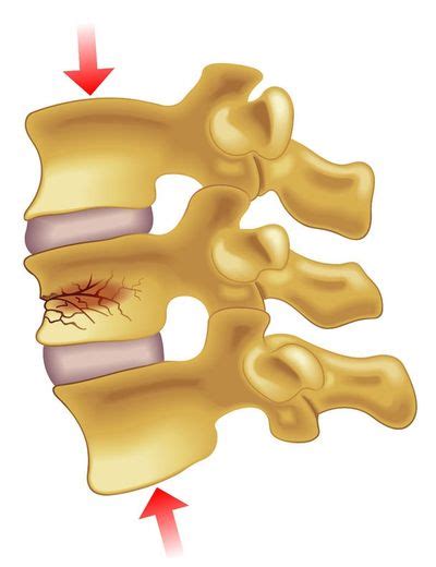 Podcast Fractura Vertebral - Podcast