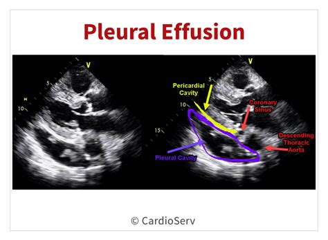 Cardiac Tamponade Echo