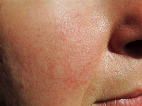 Acne Rosacea Treatment: 6 Reasons Not to Wait - Dermatology Consultants ...