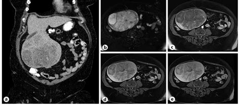 CT and MRI of the exophytic liver tumor. a Coronal contrast-enhanced CT ...