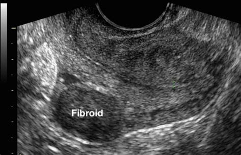 Fibroids: Types, Causes, and Symptoms - Seckin Endometriosis Center