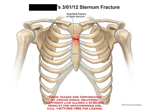 Sternum Fracture