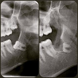 Coronectomy - surgical decoronation of impacted teeth | News | Dentagama