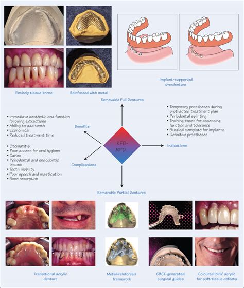 47 Removable prostheses | Pocket Dentistry