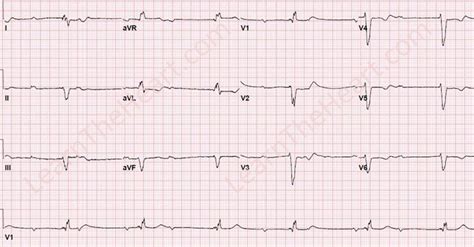 Third Degree AV Block ECG (Example 4) | Learn the Heart