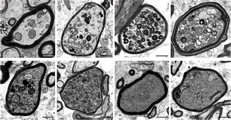 Multiple sclerosis: Myelin may be detrimental to nerve fibers