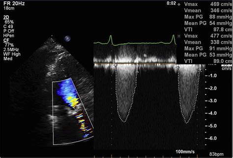 Mastering Echocardiography Aortic Stenosis All About Ultrasound | My XXX Hot Girl