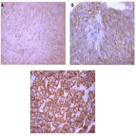 Transitional cell carcinoma of the urinary bladder. A, Intermediate... | Download Scientific Diagram