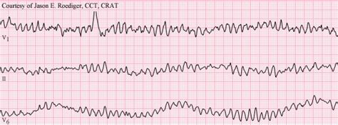 Ventricular Fibrillation ECG Criteria and Review | LearntheHeart.com