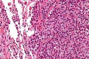 Small round cell tumours - Libre Pathology