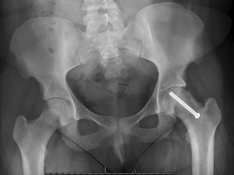 OrthoKids - Slipped Capital Femoral Epiphysis (SCFE)