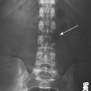 The (absent) pedicle sign known as the winking owl sign (arrow). A... | Download Scientific Diagram