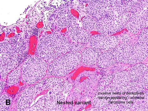 American Urological Association - Urothelial Carcinoma Variants